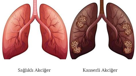 Evre 3 akciğer kanseri